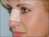 Что нужно делать, после операции на выравнивание носа.