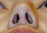 Фото к теме статьи: Ринопластика. Строение носа.