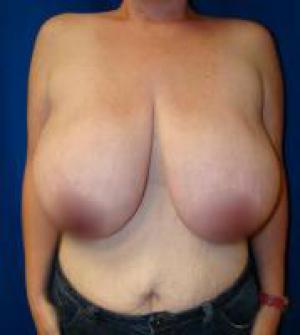 Новый тренд пластической хирургии - уменьшение груди.